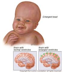 congenital hydrocephalus