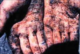 Arsenic poisoning