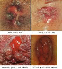 hemorroid treatment