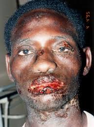 About Stevens-Johnson Syndrome