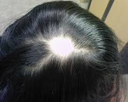alopecia picture