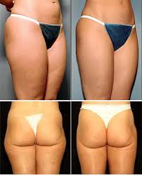 photos of liposuction