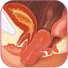 fallen uterus