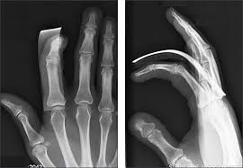 aluminum splint