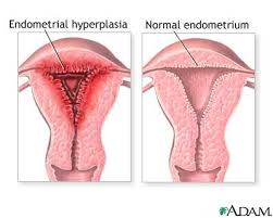 menstrual clots