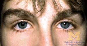 physiologic anisocoria