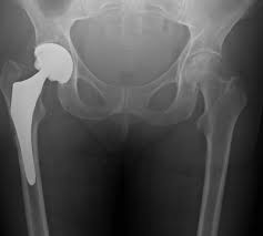 bursitis hip