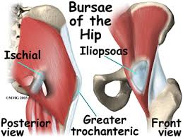 bursitis hip