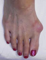 bunion operation