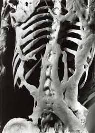 Skeleton of a person with FOP