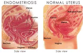 Endometriosis