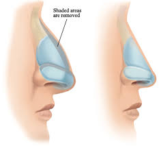 nose bone