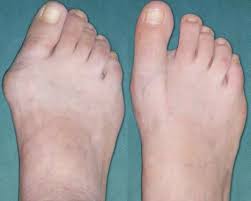 bunion operation