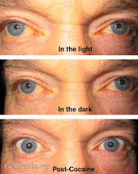 physiologic anisocoria