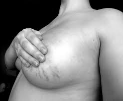 stretchmarks