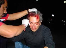 fractura de craneo