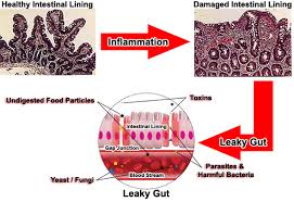 leaky gut syndrome
