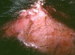 alopecia cicatricial