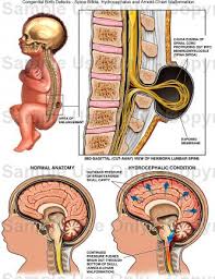 congenital hydrocephalus