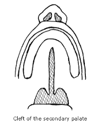 submucous cleft palate