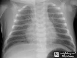 transient tachypnea of the newborn