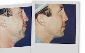 rhinoplasty