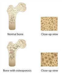 osteoporosis