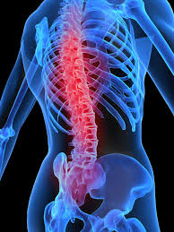 osteoporosis