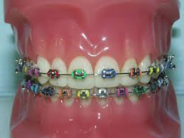 braces pictures