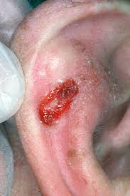 ear cancer