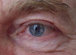 poche sous les yeux