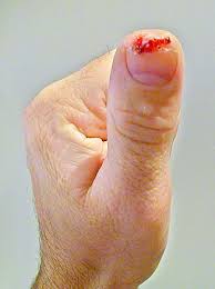finger cut