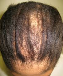 alopecia picture