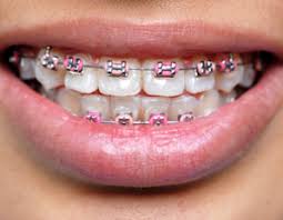 braces pictures