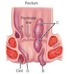 anorectal bleeding