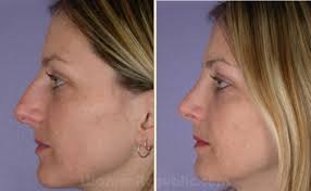 rhinoplasty