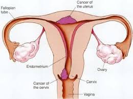 uterus cancer