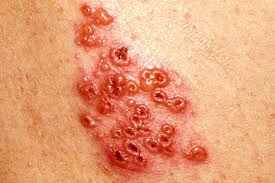 shingles virus