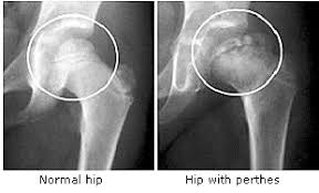 perthes disease