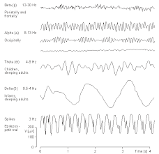 eeg patterns