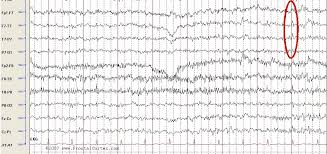 eeg patterns
