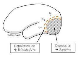 migraine symptoms