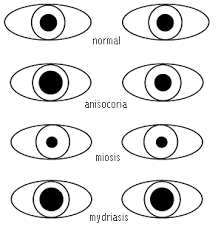 physiologic anisocoria