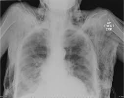 severe copd