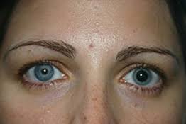 physiologic anisocoria