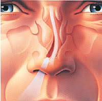 nose bone