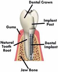 tooth cap