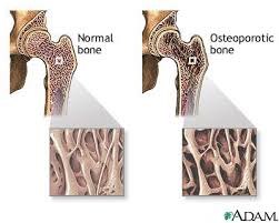 osteoporosis