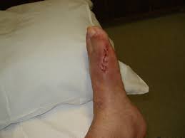 bunion operation