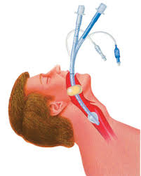 tracheal suction